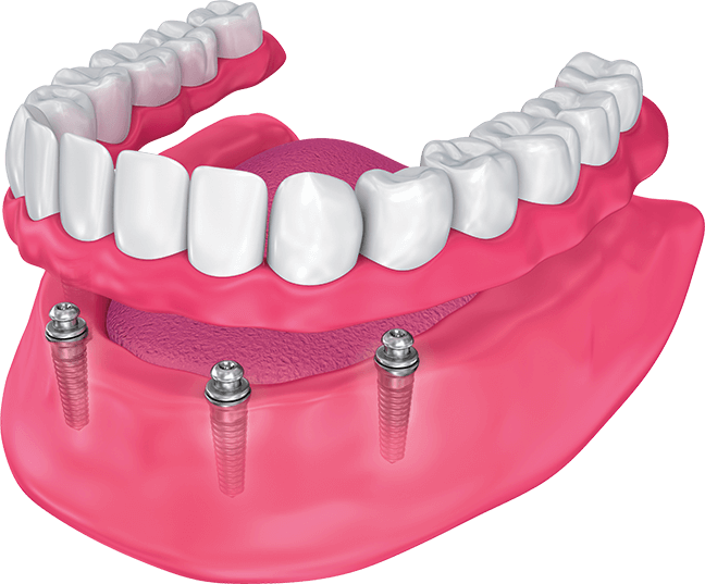 An illustrated representation of implants in a jaw with no teeth and a full-sized row of synthetic teeth over the posts.
