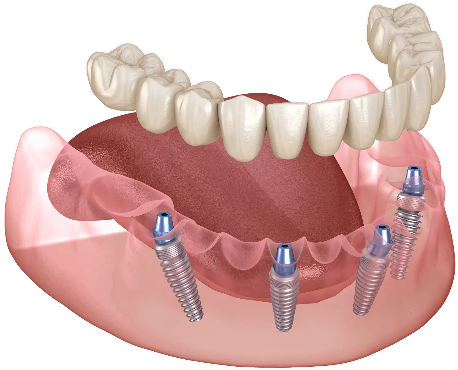 An illustrated representation of implants in a jaw with no teeth and a full-sized row of synthetic teeth over the posts. This is so-called All-on-X technology.