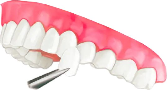 A graphic illustration of a row of teeth with a veneer being held in front of one with tweezers.