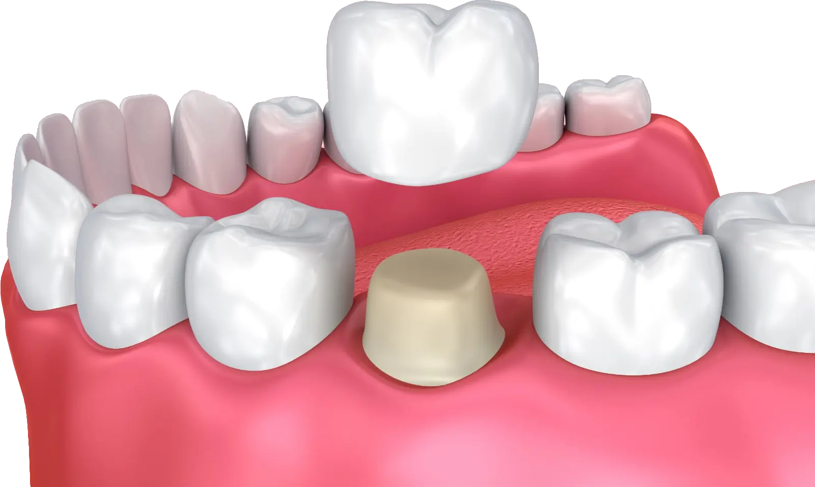 A graphic illustration of a prepped tooth being fitted with a dental crown